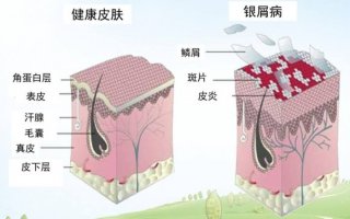 银屑病患者需要注意什么