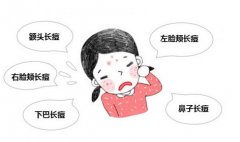 夏季如何去除青春痘