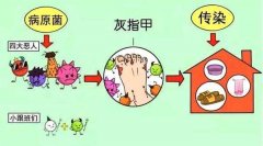 灰指甲对女性有什么影响